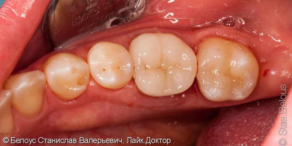 Лечение кариеса зуба 37, лечение каналов в зубе 36, установка CAD/CAM коронок, до и после - фото №6