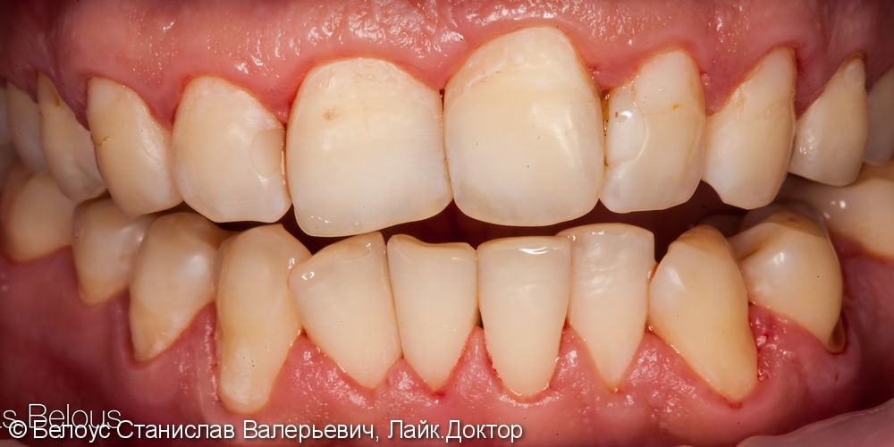Результат профессиональной чистки зубов, до и после - фото №2