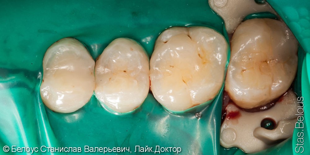 Лечение кариеса в двух зубах за одно посещение - фото №2