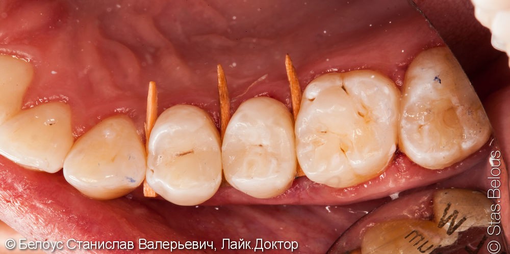 Лечение кариеса в двух зубах за одно посещение - фото №4