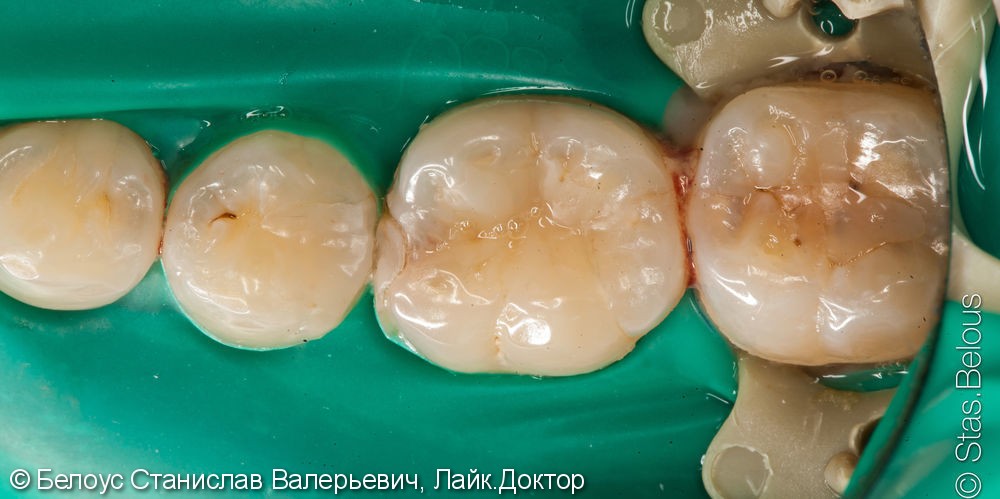 Лечение кариеса в 3-х жевательных зубах и установка «световых пломб» за одно посещение - фото №2