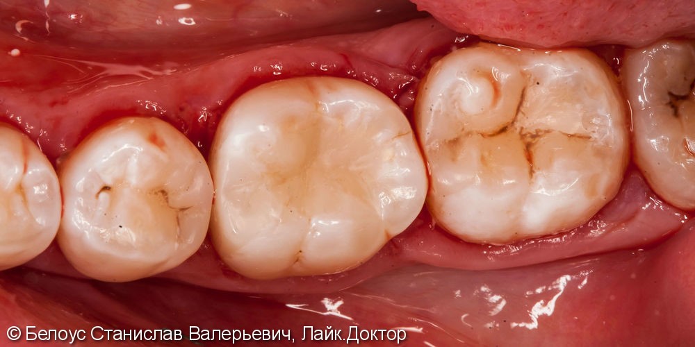Лечение кариеса в 3-х жевательных зубах и установка «световых пломб» за одно посещение - фото №5