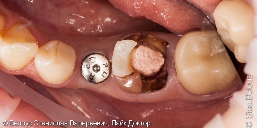Коронка CEREC на имплант и классическая коронка на зуб, до и после - фото №1