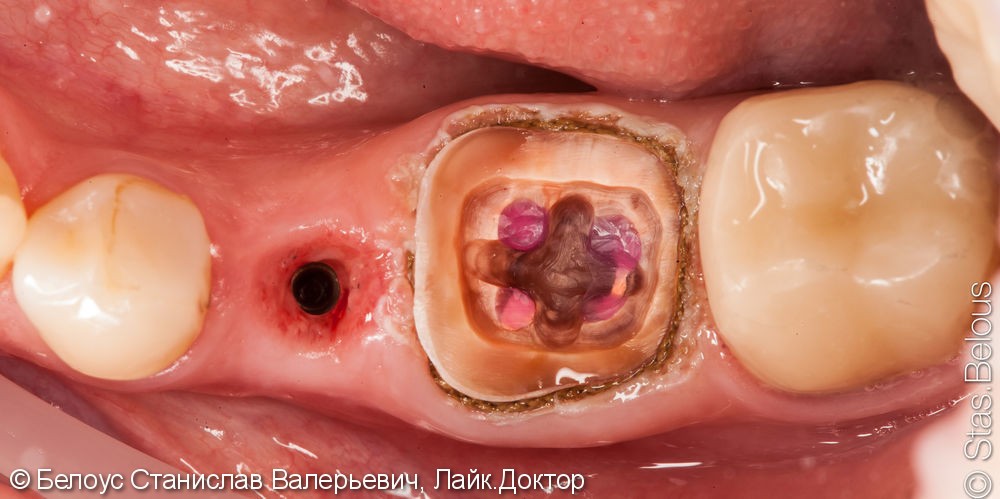 Коронка CEREC на имплант и классическая коронка на зуб, до и после - фото №2