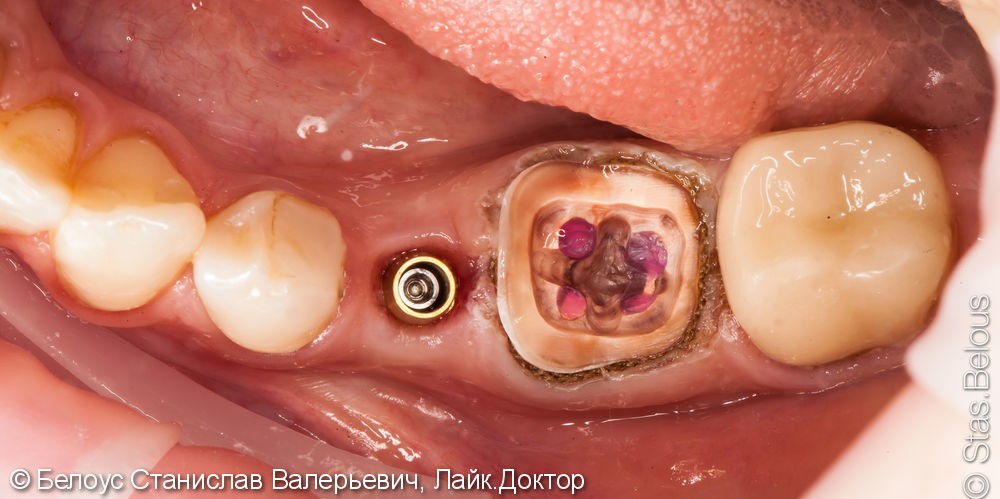 Коронка CEREC на имплант и классическая коронка на зуб, до и после - фото №3