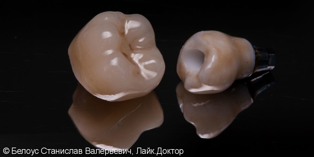 Коронка CEREC на имплант и классическая коронка на зуб, до и после - фото №4