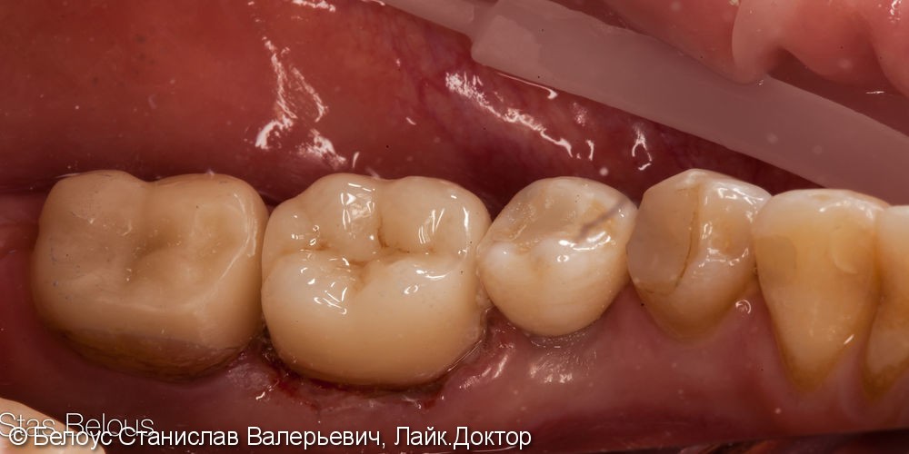 Коронка CEREC на имплант и классическая коронка на зуб, до и после - фото №5
