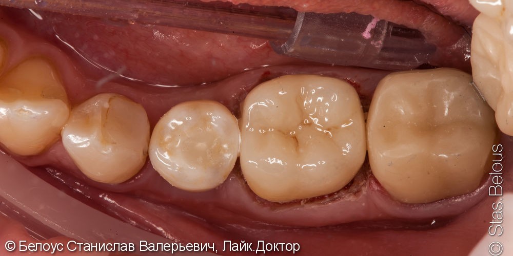 Коронка CEREC на имплант и классическая коронка на зуб, до и после - фото №6
