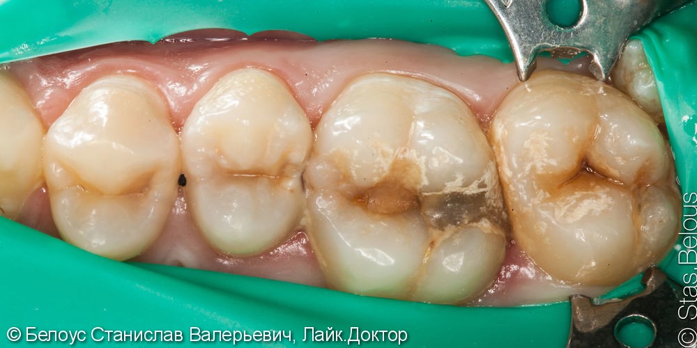 Реставрация полностью разрушенного зуба по цифровому CAD/CAM протоколу, до и после - фото №3