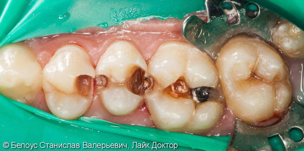 Реставрация полностью разрушенного зуба по цифровому CAD/CAM протоколу, до и после - фото №2
