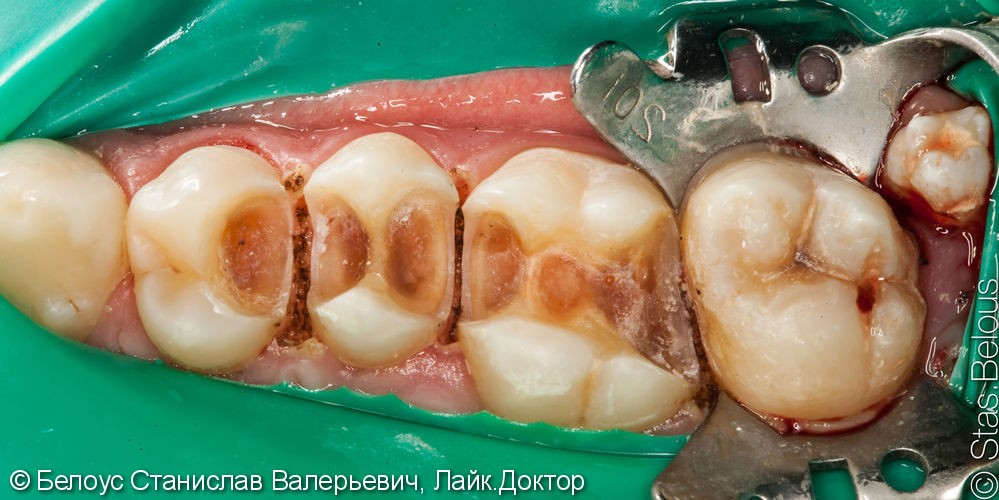 Реставрация полностью разрушенного зуба по цифровому CAD/CAM протоколу, до и после - фото №4