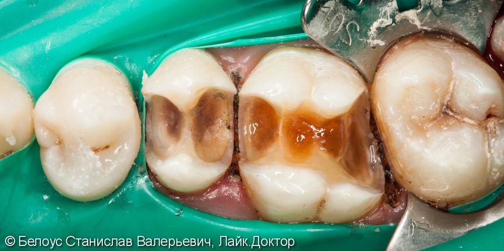 Реставрация полностью разрушенного зуба по цифровому CAD/CAM протоколу, до и после - фото №6