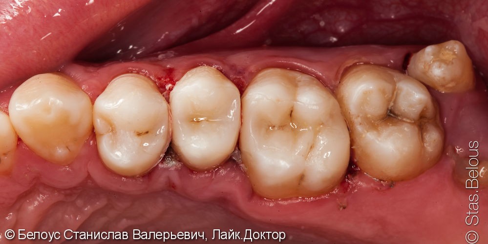 Реставрация полностью разрушенного зуба по цифровому CAD/CAM протоколу, до и после - фото №7