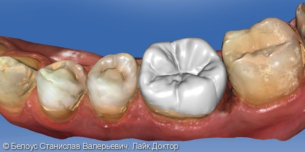 Лечение периодонтита и установка коронки по технологии CEREC из немецкой керамики, до и после - фото №1