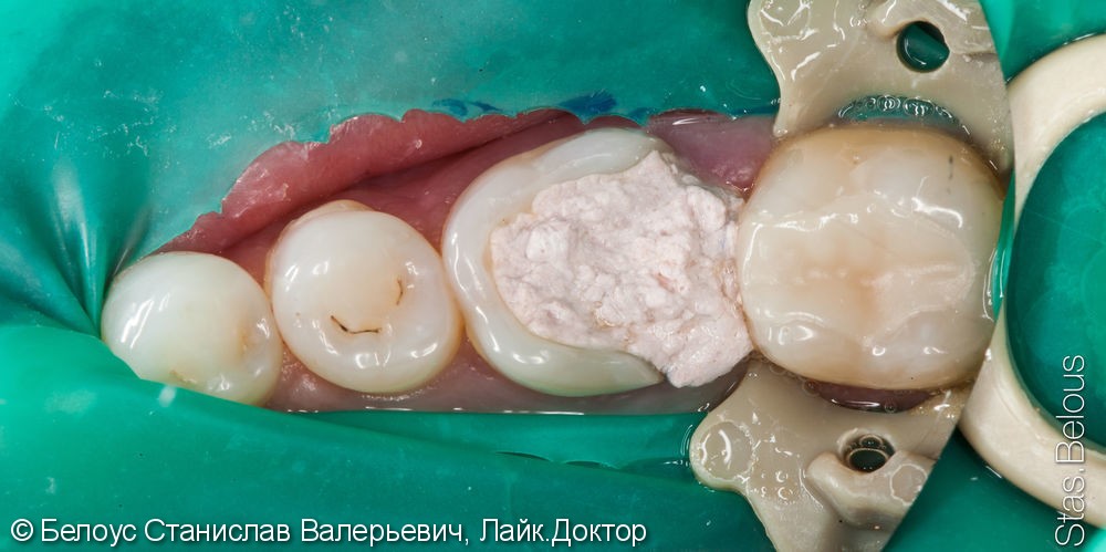Лечение периодонтита и установка коронки по технологии CEREC из немецкой керамики, до и после - фото №2