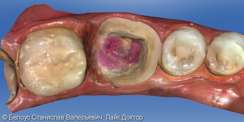 Лечение периодонтита и установка коронки по технологии CEREC из немецкой керамики, до и после - фото №4
