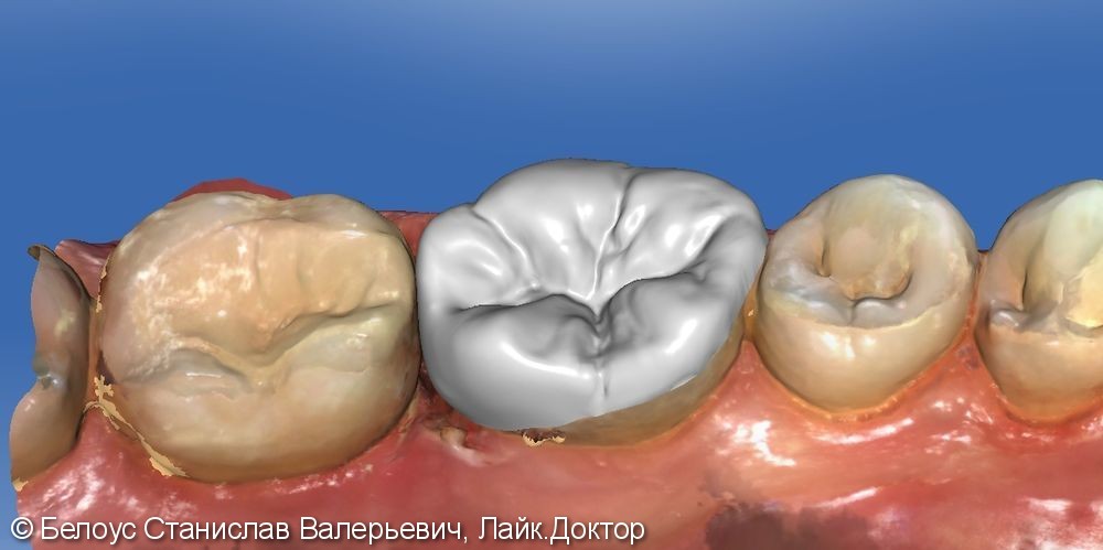 Лечение периодонтита и установка коронки по технологии CEREC из немецкой керамики, до и после - фото №5