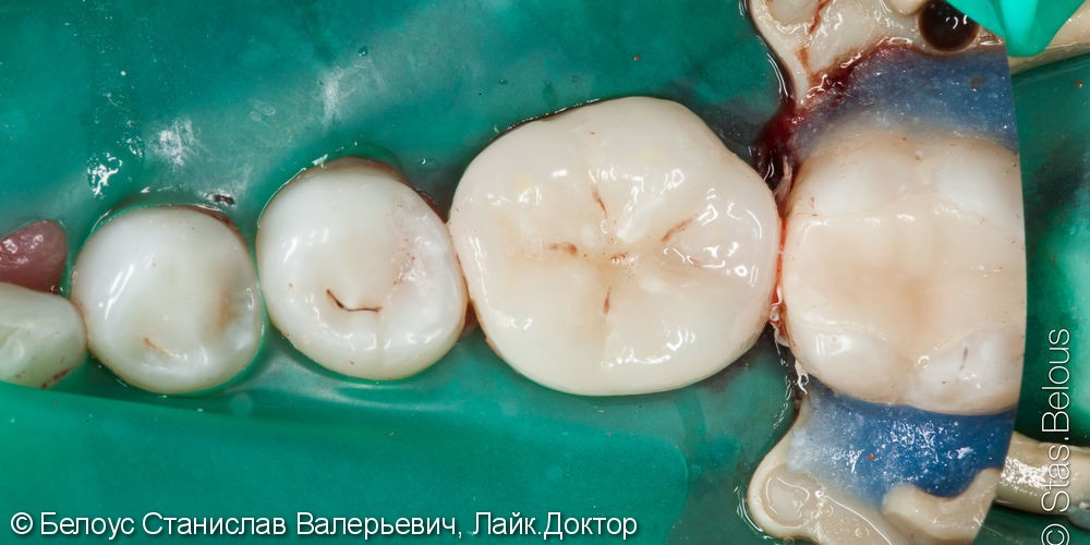 Лечение периодонтита и установка коронки по технологии CEREC из немецкой керамики, до и после - фото №7