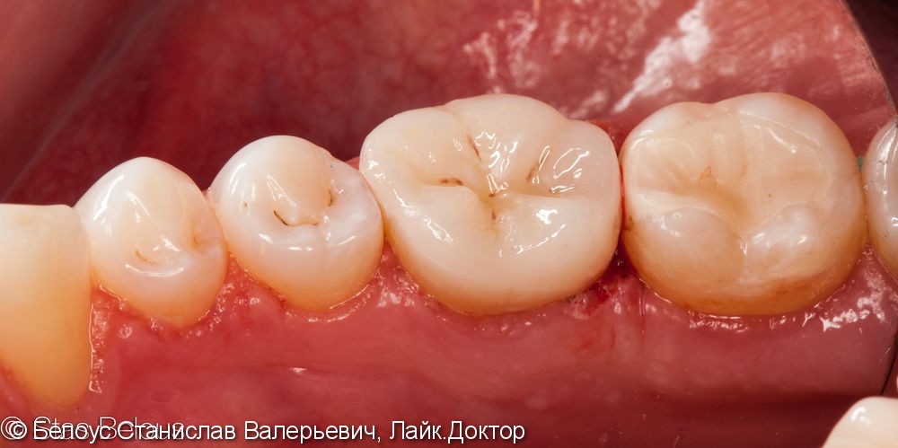 Лечение периодонтита и установка коронки по технологии CEREC из немецкой керамики, до и после - фото №8