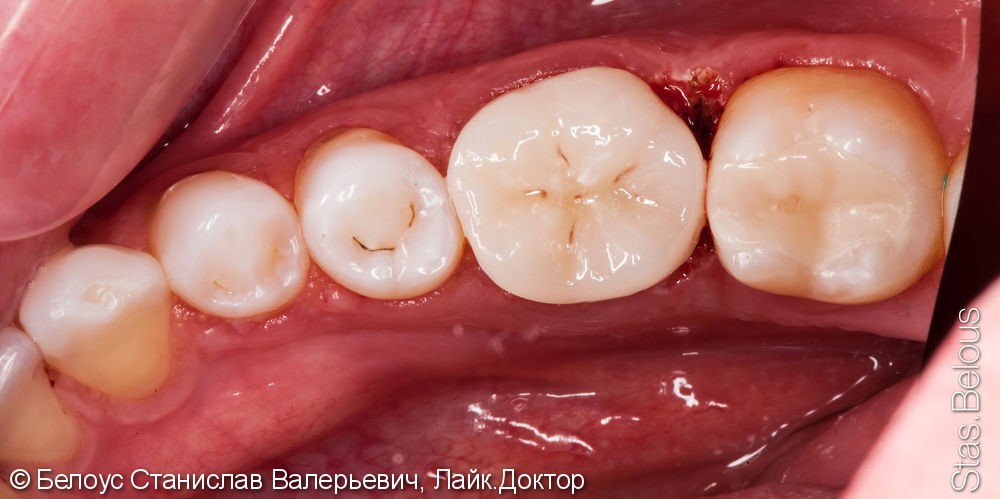 Лечение периодонтита и установка коронки по технологии CEREC из немецкой керамики, до и после - фото №9