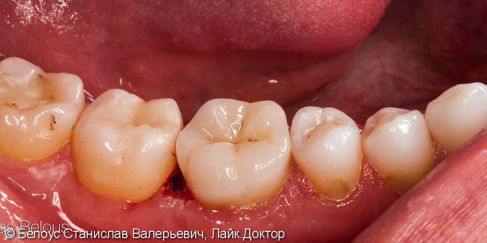 Лечение периодонтита и установка коронки по технологии CEREC из немецкой керамики, до и после - фото №10
