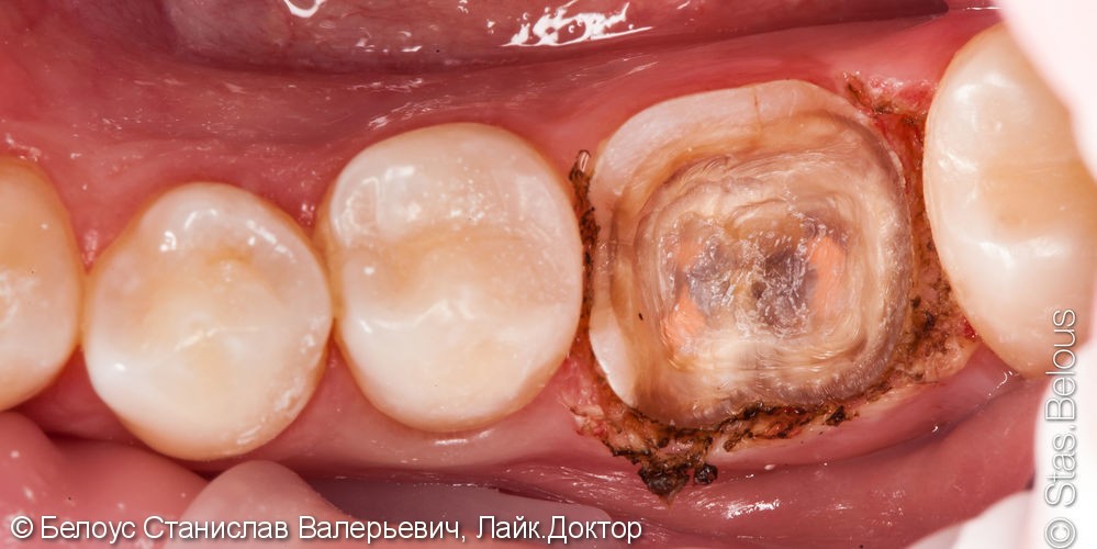 Реставрация полностью разрушенного зуба CAD/CAM коронкой, дои после - фото №2