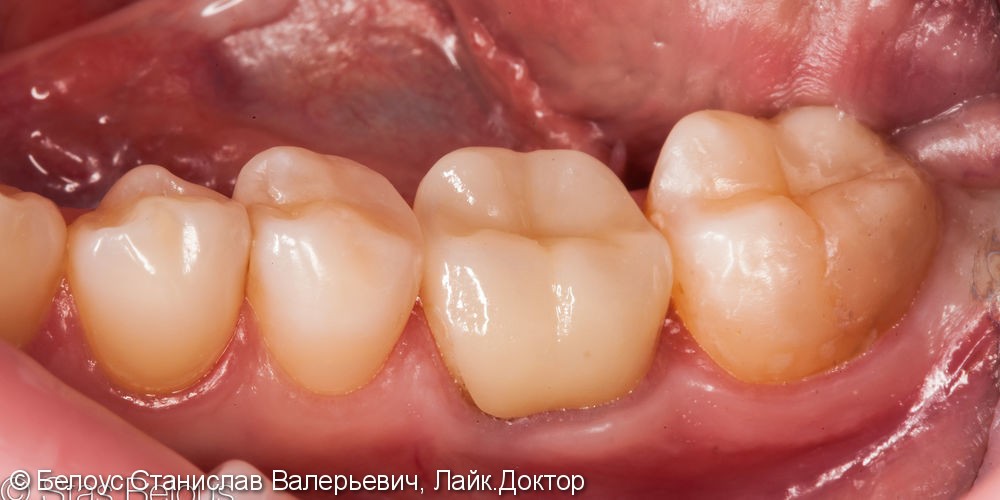 Реставрация полностью разрушенного зуба CAD/CAM коронкой, дои после - фото №5