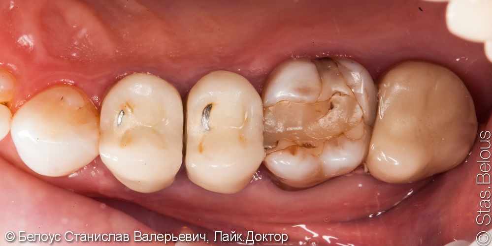Лечение каналов и установка 3х CAD/CAM коронок на жевательные зубы за два посещения - фото №1