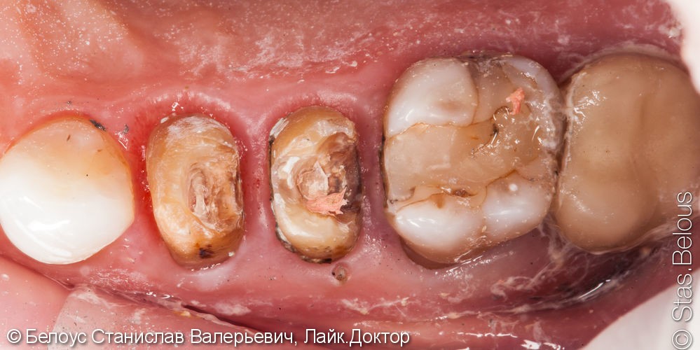 Лечение каналов и установка 3х CAD/CAM коронок на жевательные зубы за два посещения - фото №2