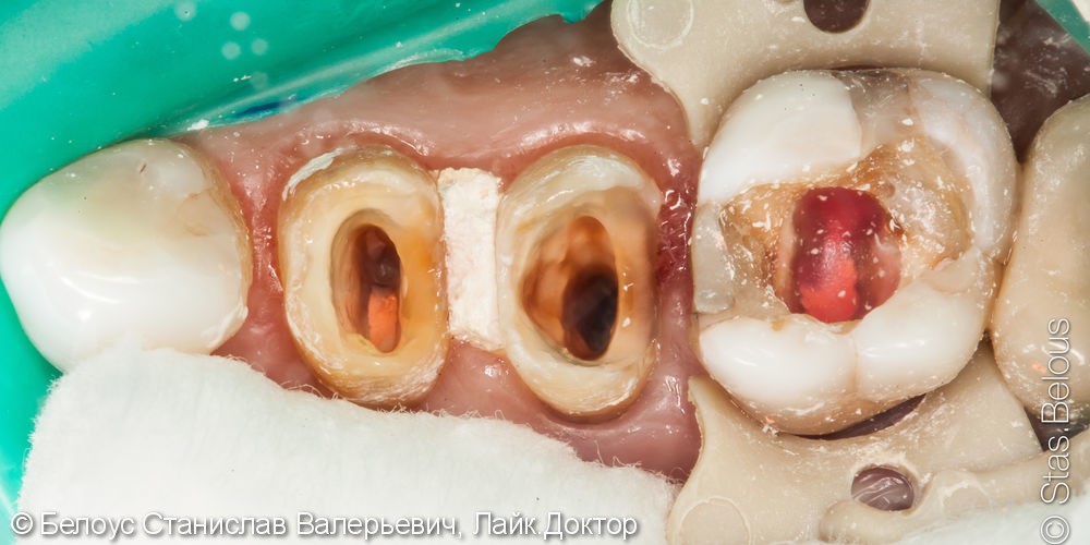 Лечение каналов и установка 3х CAD/CAM коронок на жевательные зубы за два посещения - фото №3