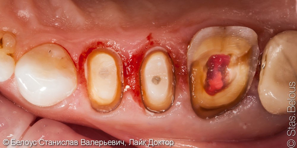 Лечение каналов и установка 3х CAD/CAM коронок на жевательные зубы за два посещения - фото №4