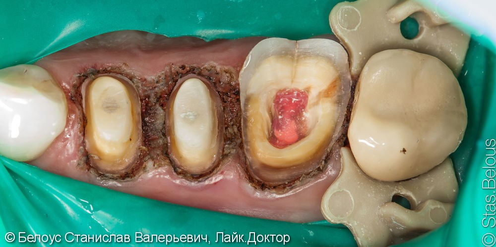 Лечение каналов и установка 3х CAD/CAM коронок на жевательные зубы за два посещения - фото №6