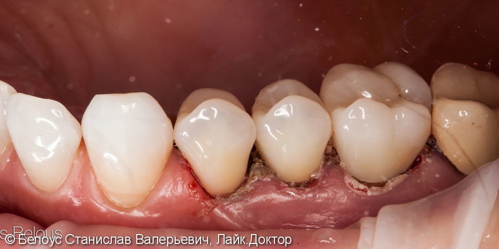 Лечение каналов и установка 3х CAD/CAM коронок на жевательные зубы за два посещения - фото №7