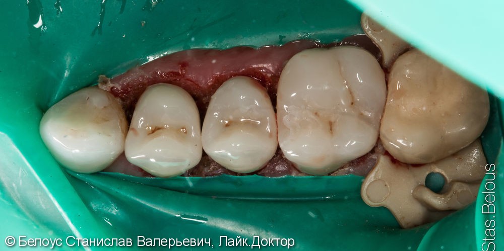 Лечение каналов и установка 3х CAD/CAM коронок на жевательные зубы за два посещения - фото №9