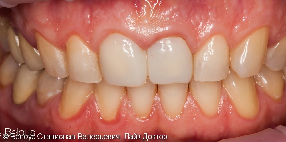 Две коронки Cerec на передние зубы за 1 день, до и после - фото №1