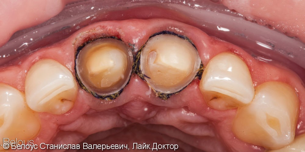 Две коронки Cerec на передние зубы за 1 день, до и после - фото №2