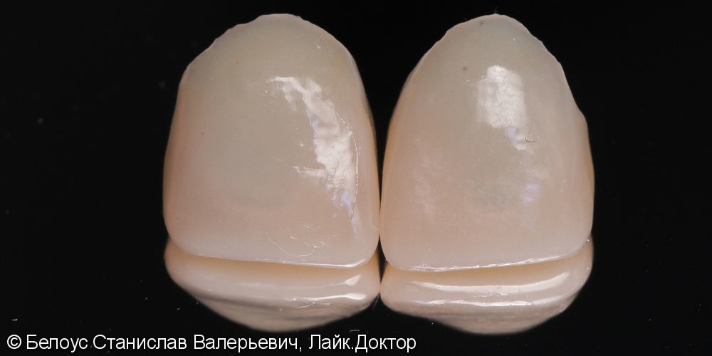 Две коронки Cerec на передние зубы за 1 день, до и после - фото №4