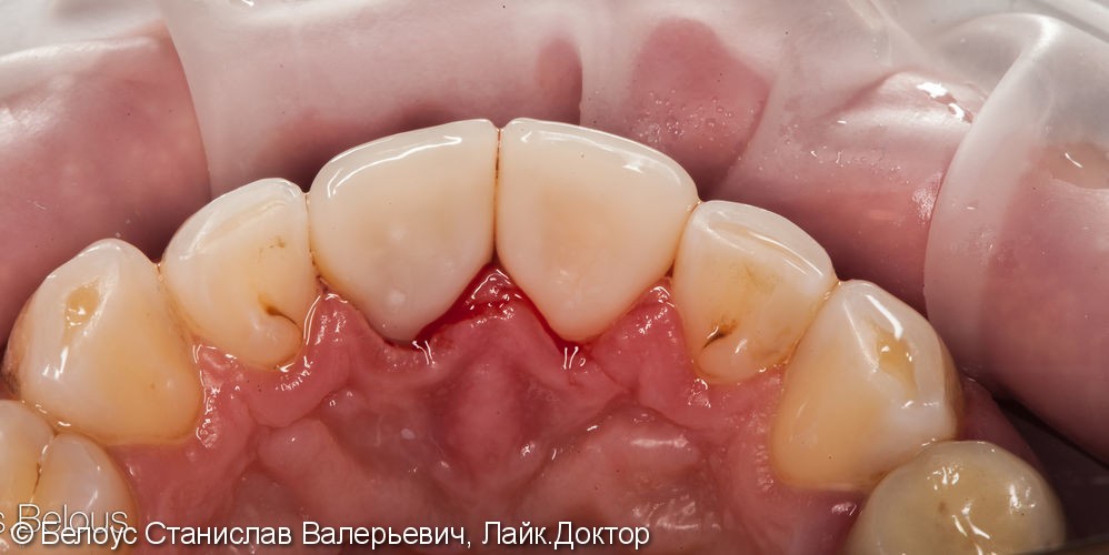 Две коронки Cerec на передние зубы за 1 день, до и после - фото №5