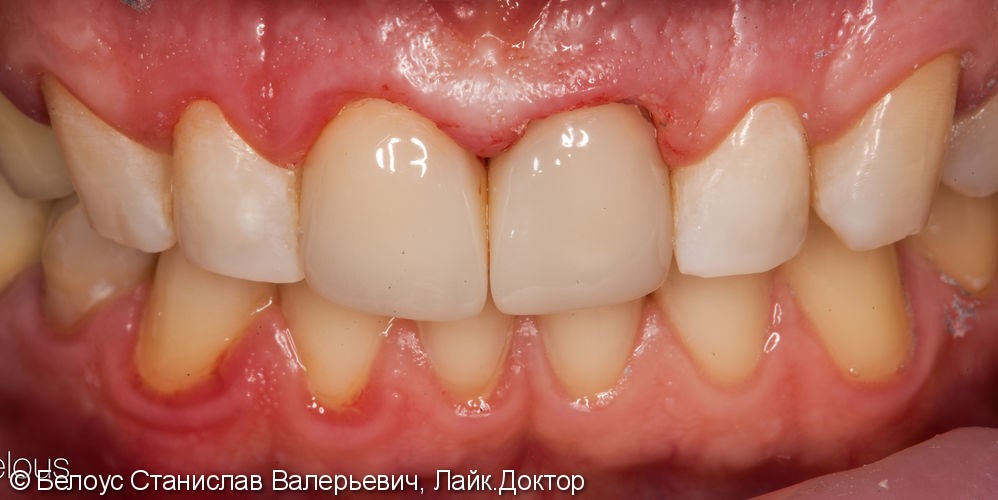 Две коронки Cerec на передние зубы за 1 день, до и после - фото №9