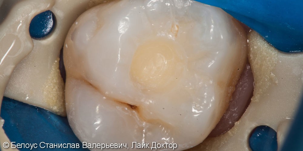 Лечение кариеса 16 зуба и постановка композитной световой пломбы - фото №1