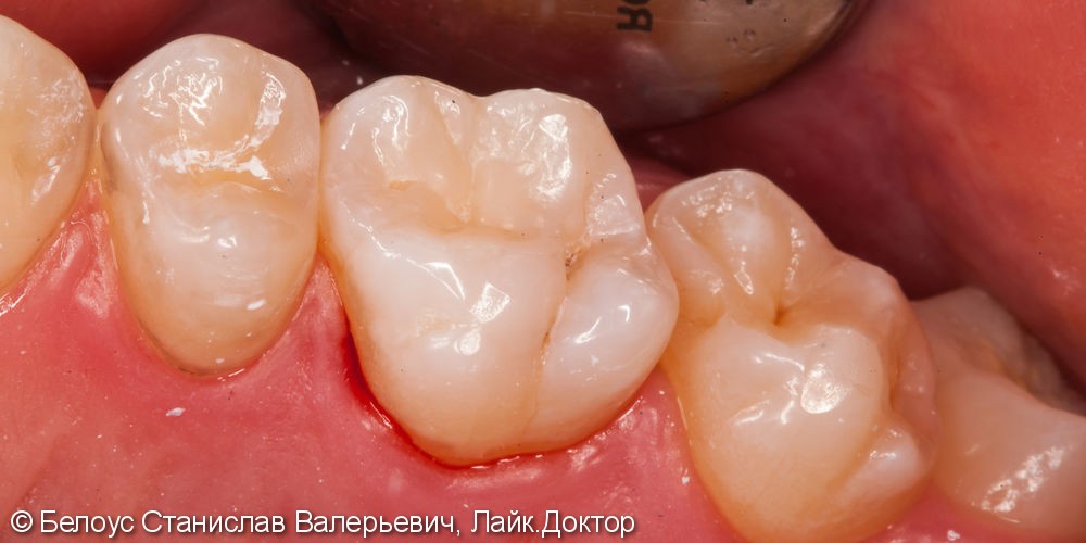 Лечение кариеса 16 зуба и постановка композитной световой пломбы - фото №3