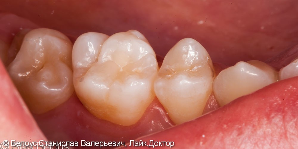 Лечение кариеса 16 зуба и постановка композитной световой пломбы - фото №4