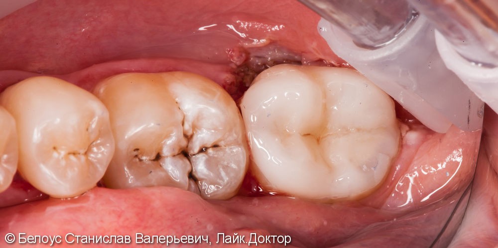 Лечение пульпита под микроскопом, в зубе 3 канала, керамическая полукоронка - фото №7