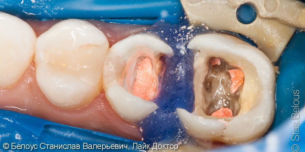 Лечение каналов в зубах с микроскопом и установка Церек коронок - фото №1