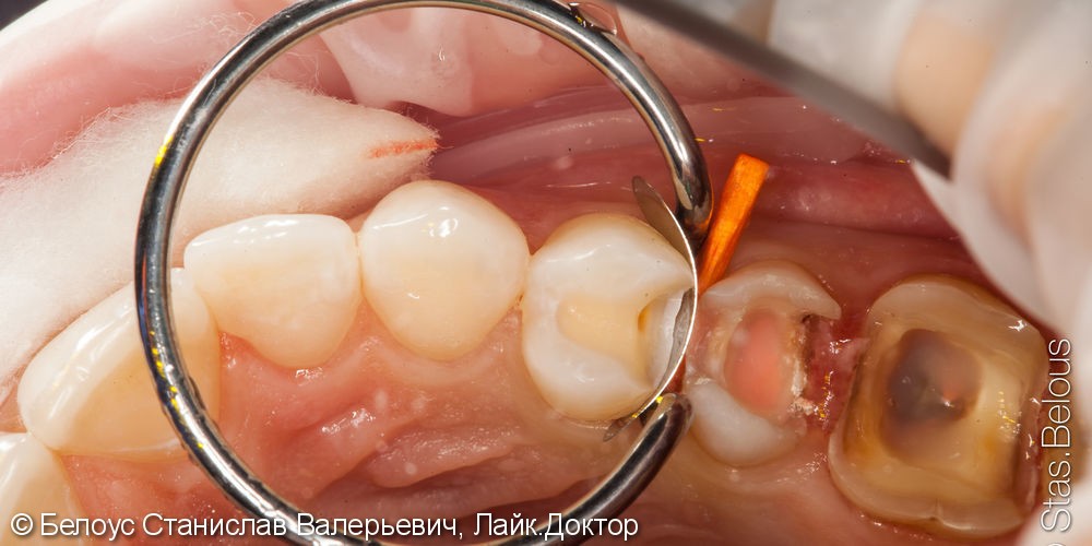 Лечение каналов в зубах с микроскопом и установка Церек коронок - фото №2
