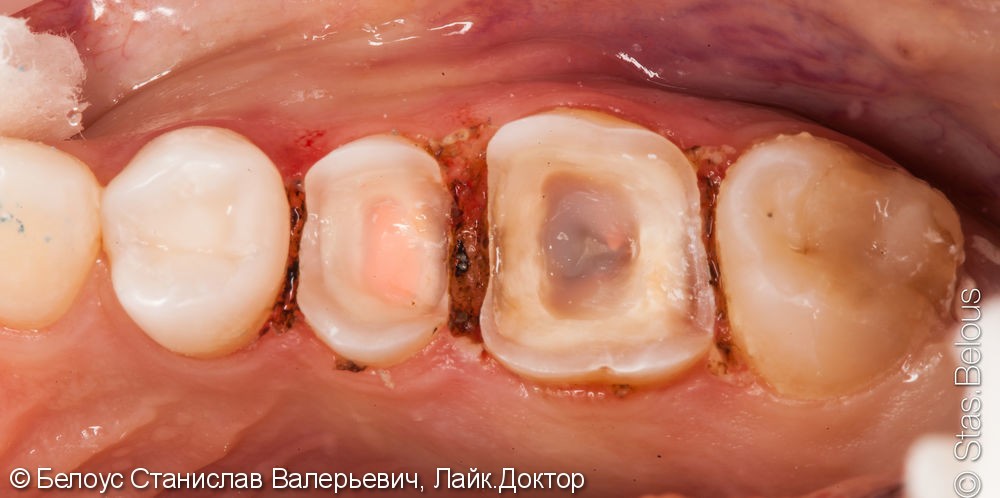 Лечение каналов в зубах с микроскопом и установка Церек коронок - фото №3