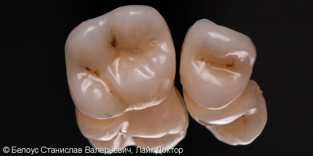 Лечение каналов в зубах с микроскопом и установка Церек коронок - фото №4
