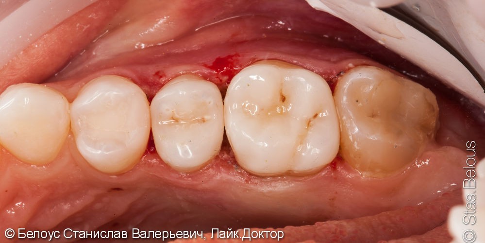 Лечение каналов в зубах с микроскопом и установка Церек коронок - фото №5