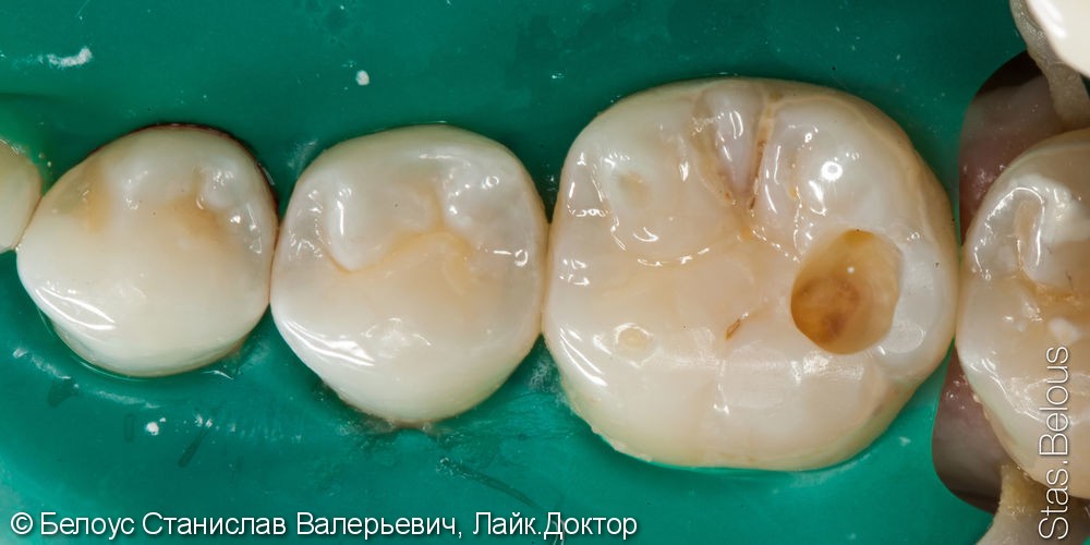 Лечение кариеса и художественная реставрация 46 зуба - фото №2