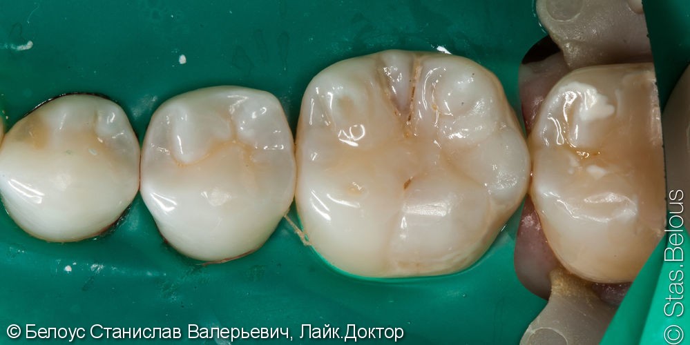 Лечение кариеса и художественная реставрация 46 зуба - фото №3